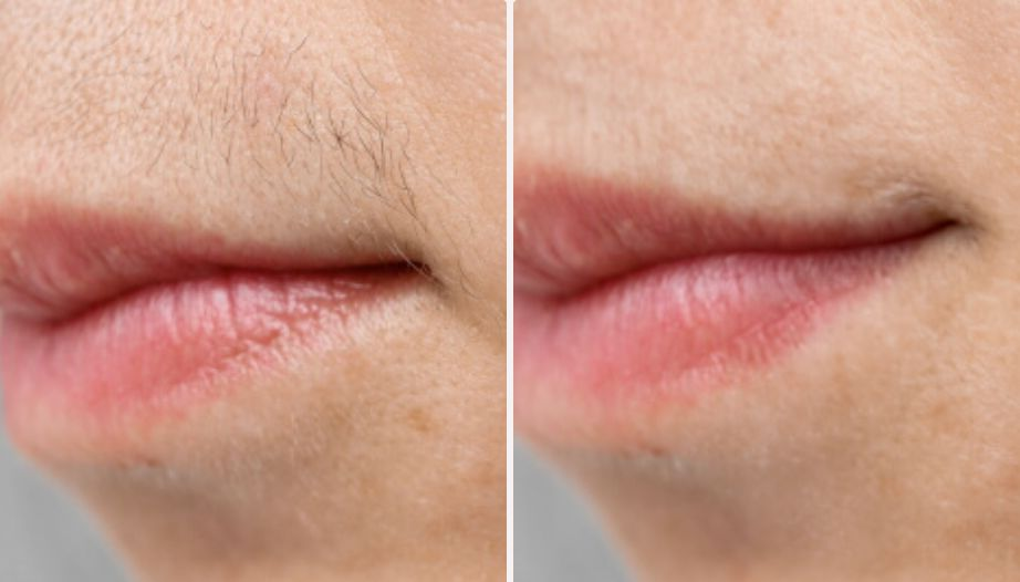 Upper Lip Hair Reduction Result 1 - Before and After