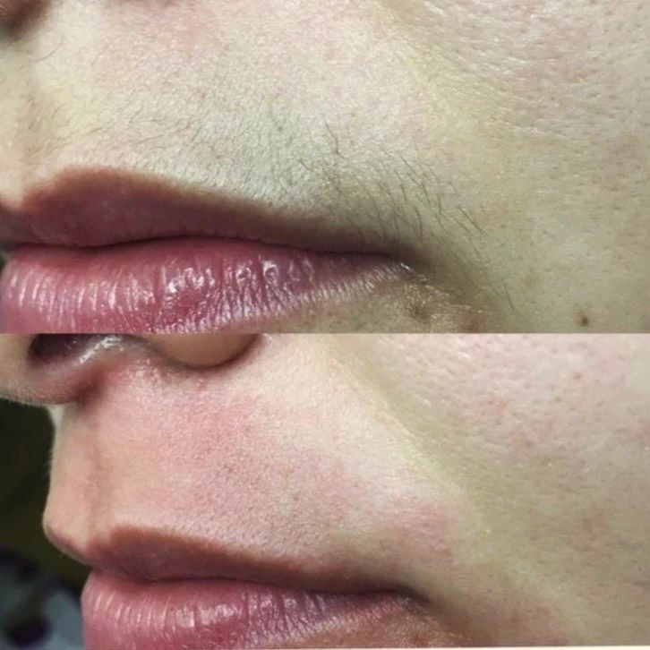 Upper Lip Hair Reduction Result 2 - Before and After