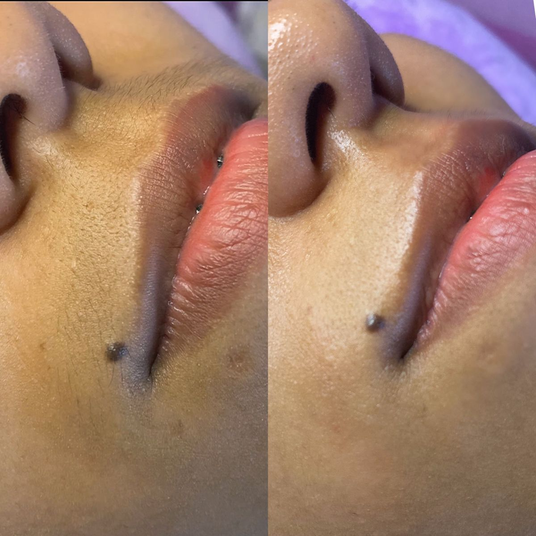 Upper Lip Hair Reduction Result 3 - Before and After