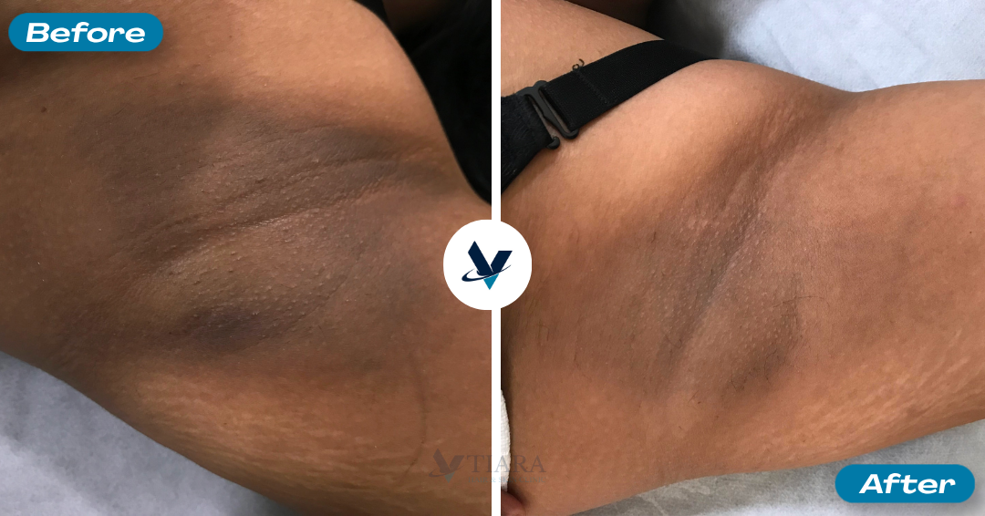 Pigmentation Treatment Result 1 - Before and After