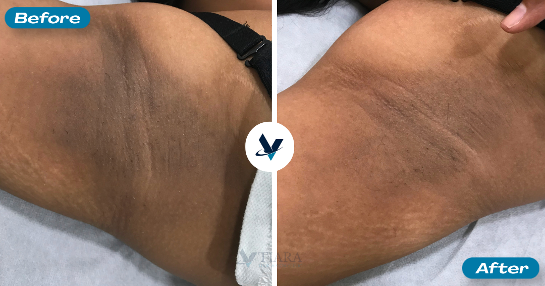 Pigmentation Treatment Result 2 - Before and After