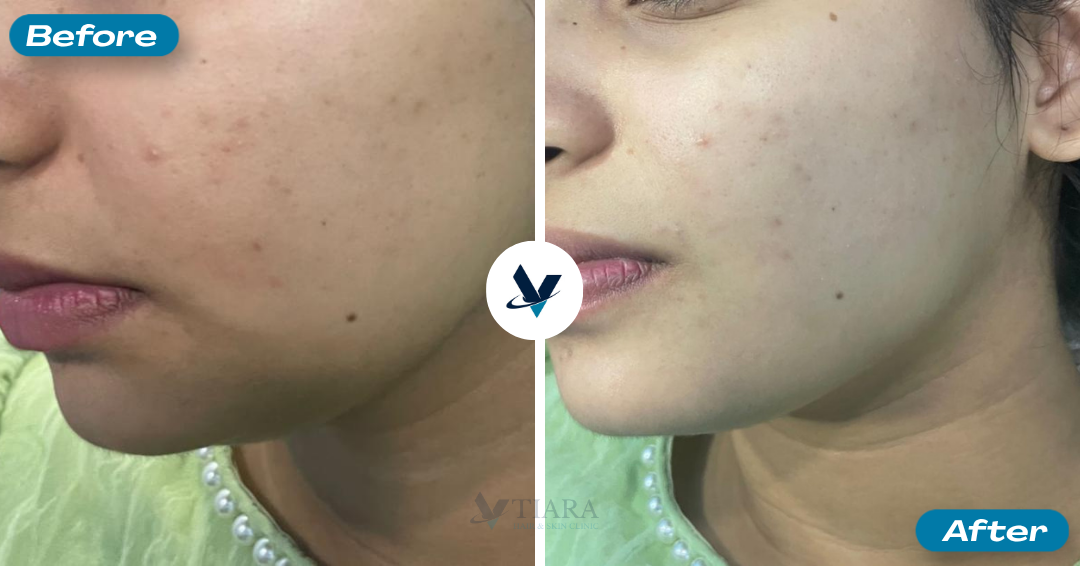 Pigmentation Treatment Result 3 - Before and After