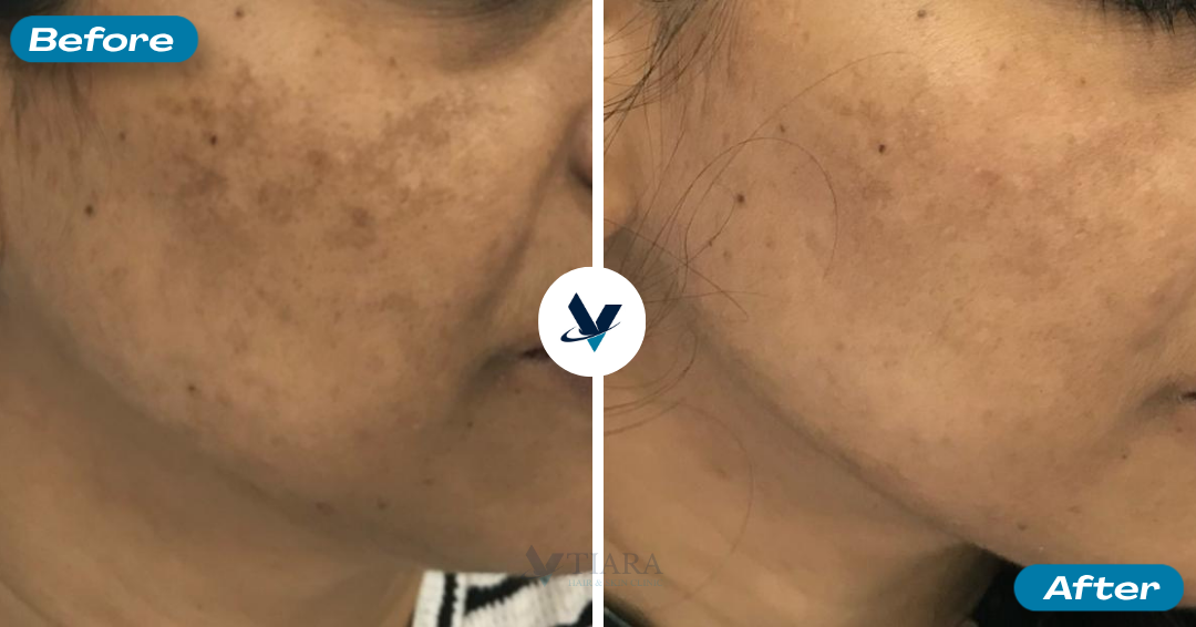 Pigmentation Treatment Result 4 - Before and After