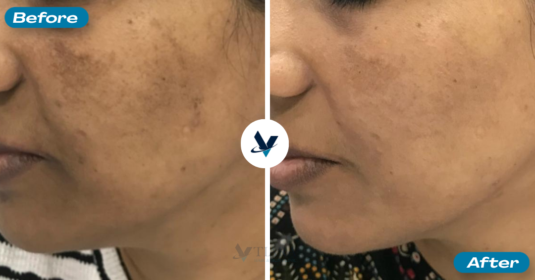 Pigmentation Treatment Result 5 - Before and After