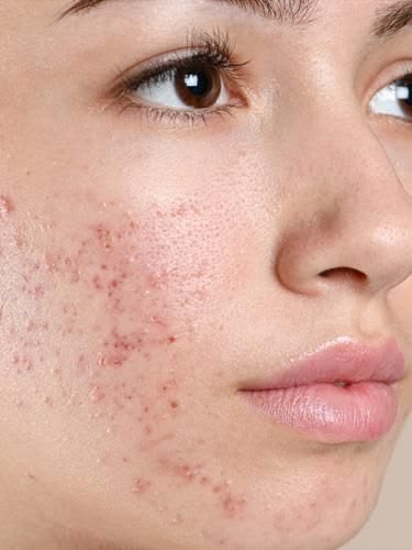 Acne Scar Treatment