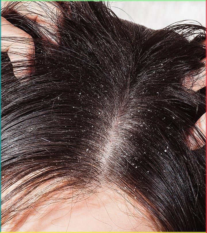 Dandruff Treatment