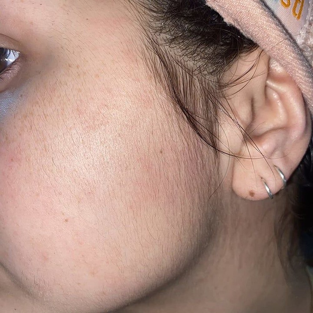 Acne Treatment