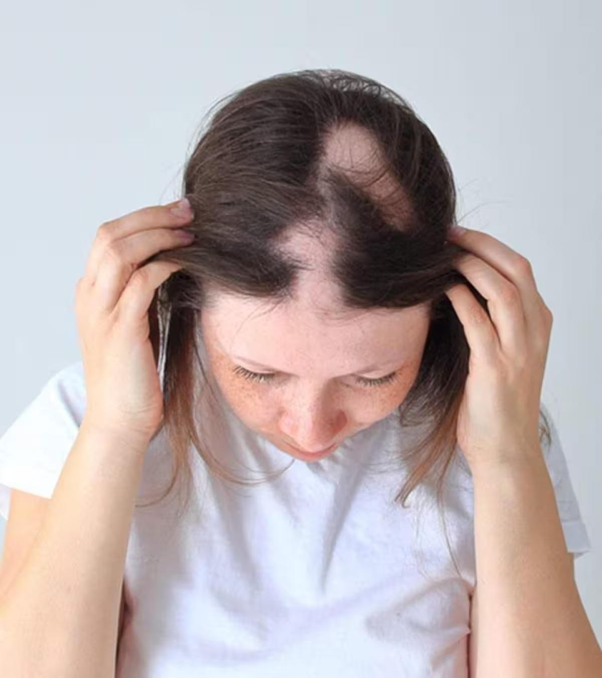 Hair Loss Treatment