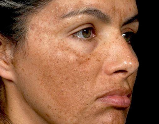 Melasma Treatment