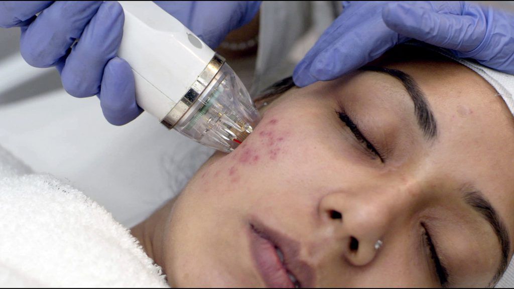 MNRF Treatment