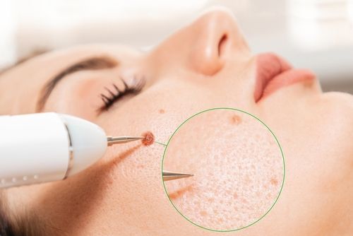 Moles Removal