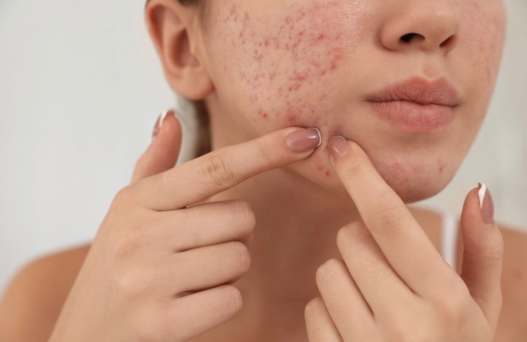 Pimple Treatment