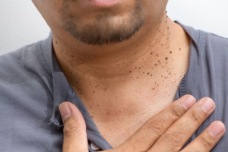 Skin Tag Removal