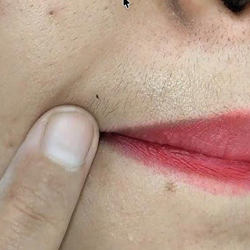 Upper Lip Hair Reduction