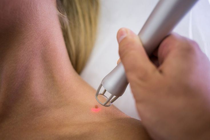 Warts Removal
