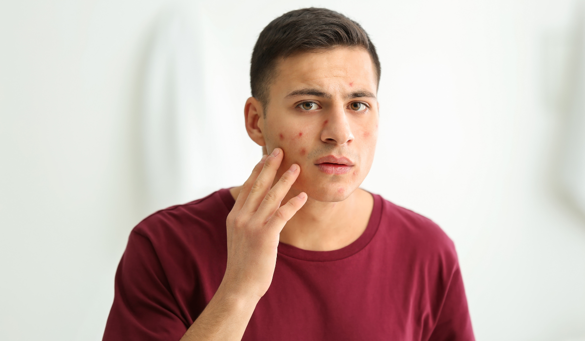 Acne Cause and treatment