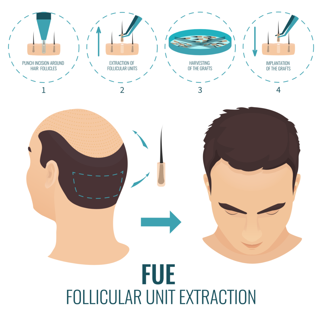 Process of Hair Transplant in Bangalore