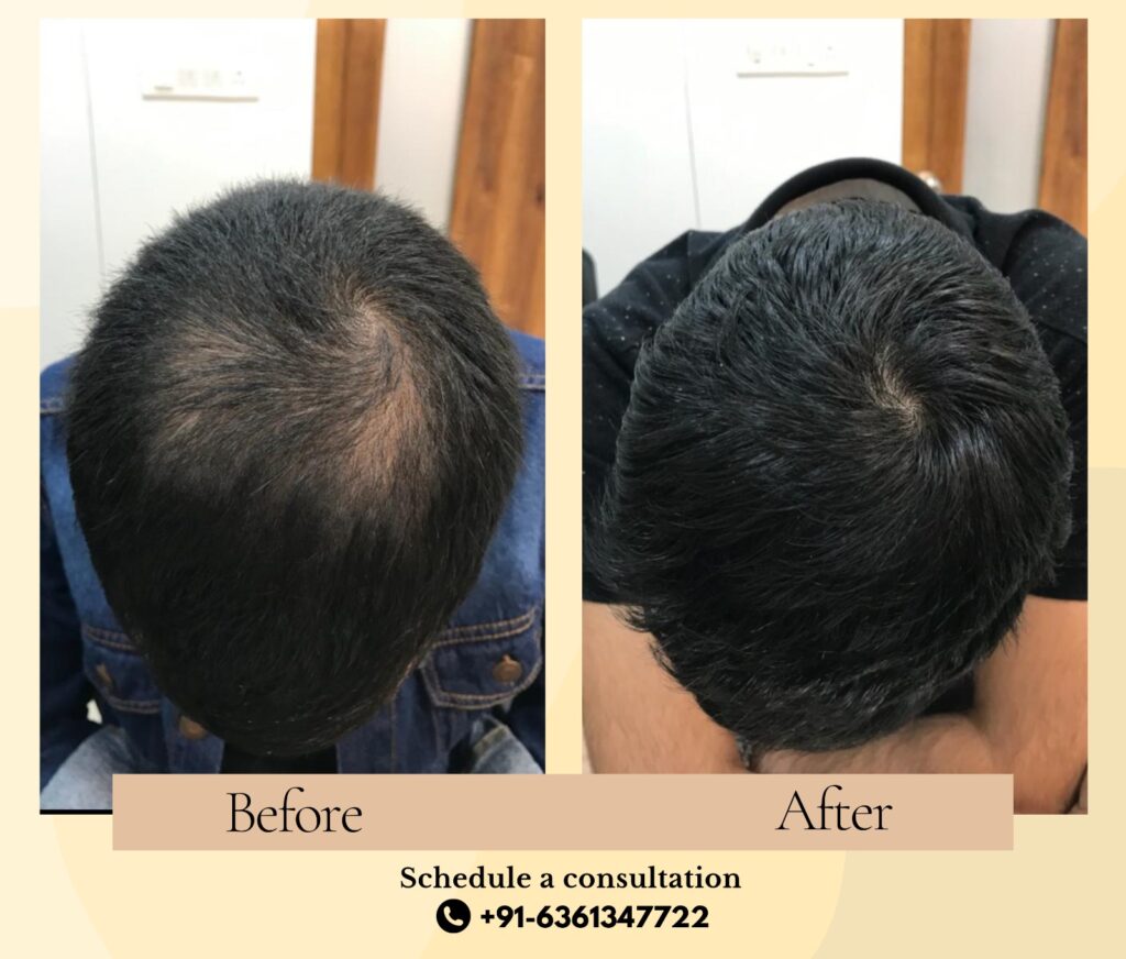 Hair Loss Treatment in Bangalore