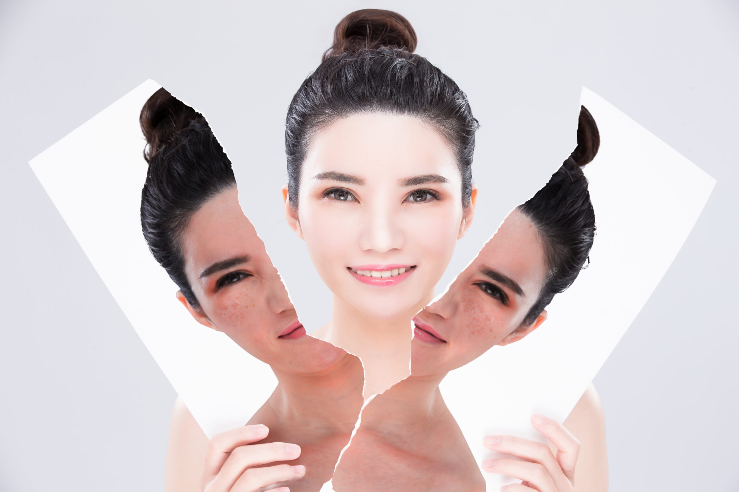 Melasma Treatment