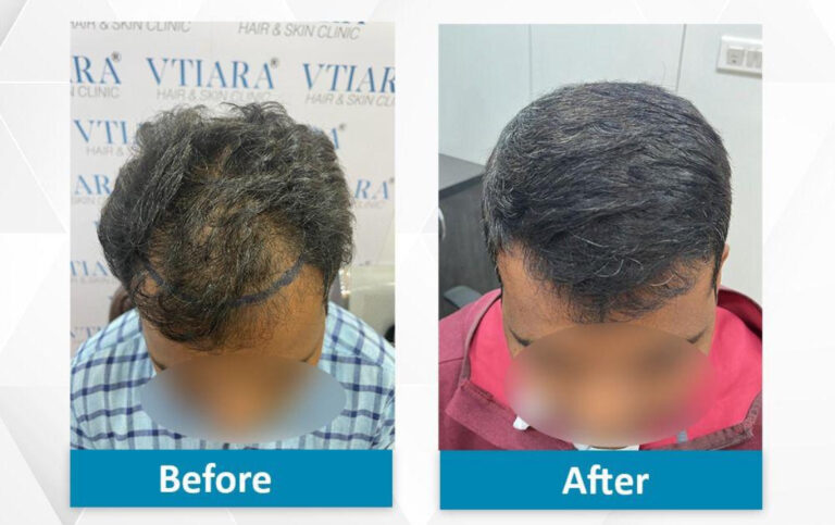 Hair Transplant Bangalore