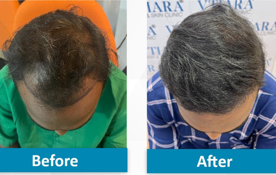 Hair Transplant