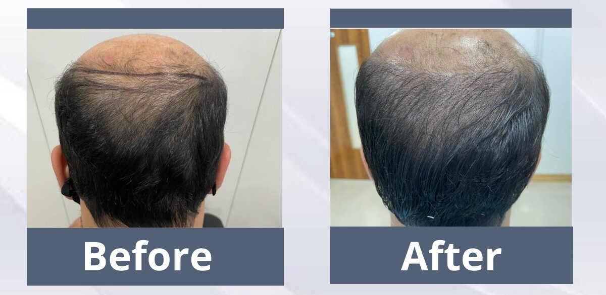 Scalp Micropigmentation