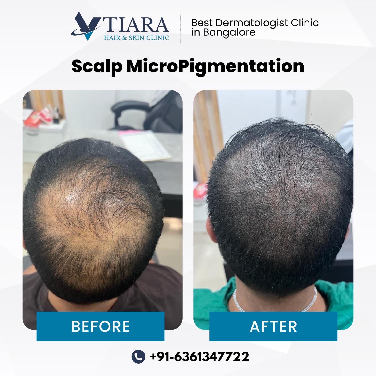 Scalp Micropigmentation