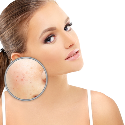 acne scar treatment in bangalore