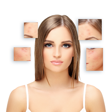 best acne treatment in bangalore