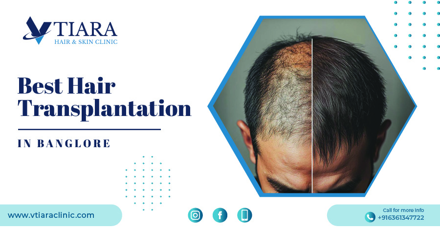 Best Hair Transplantation in bangalore