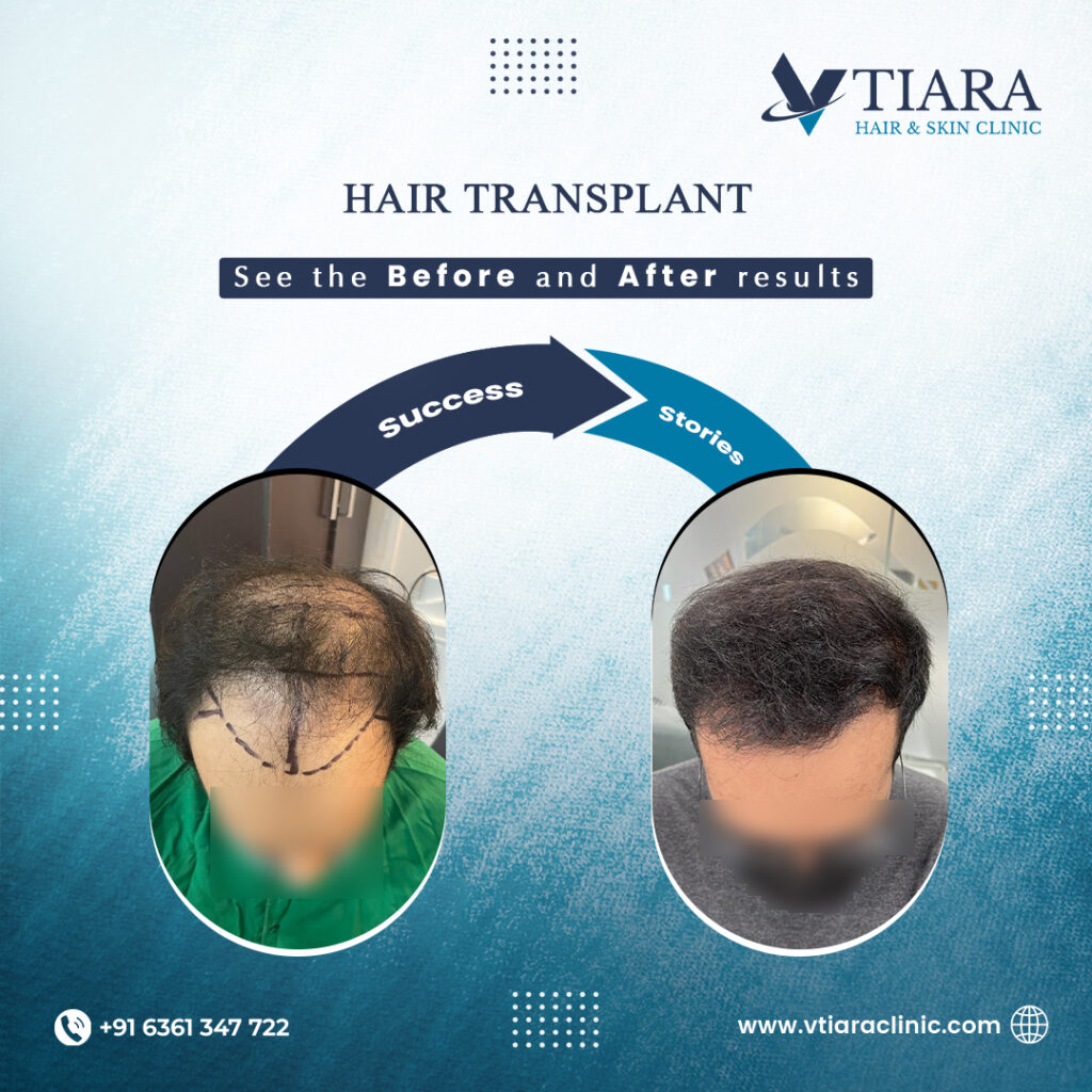 hair transplantation cost in bangalore before after