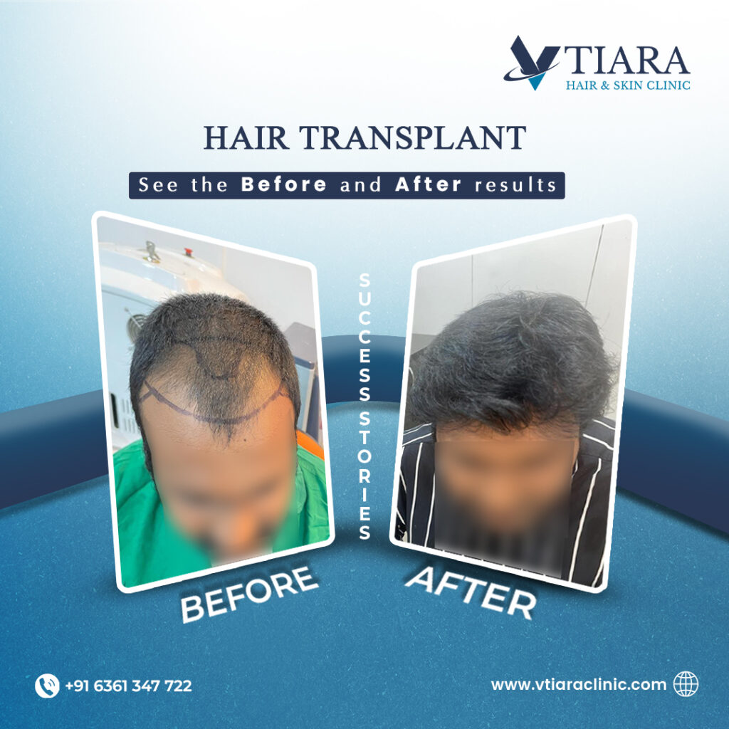 hair transplantation in bangalore before after